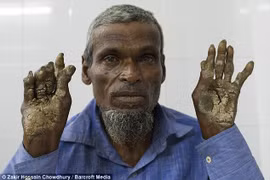 Kỳ lạ cả gia đình 3 người mắc hội chứng người cây 