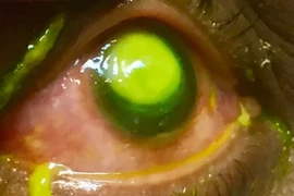 Đeo kính áp tròng ngủ qua đêm bị vi khuẩn ăn mòn giác mạc