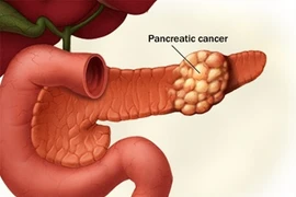 Truy nguyên nhân ung thư tuyến tụy từ 4 bệnh khác nhau