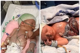 Xót lòng em bé sinh ra với bộ ruột ngoài cơ thể