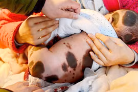 Thương tâm em bé sinh ra với vết đốm toàn cơ thể