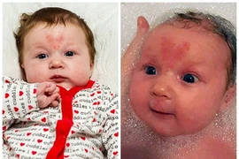 Bé thụ thai ngày 14/2 với vết bớt hình trái tim