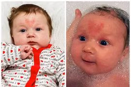 Bé thụ thai ngày 14/2 với vết bớt hình trái tim