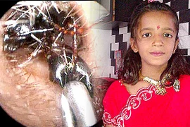 Rùng mình ổ kiến sống lâu năm trong tai bé gái