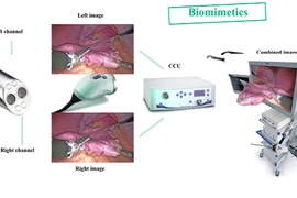 Phẫu thuật nội soi 3D lần đầu tiên tại Việt Nam