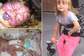 Thương tâm em bé xinh đẹp đầy vết chàm tím trên mặt