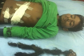 Hãi hùng nam thanh niên mang bào thai ký sinh 18 năm