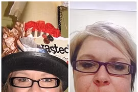 Kỳ lạ loại ung thư xúc hiếm gặp lan toàn cơ thể