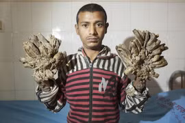 Kinh hãi người đàn ông mắc hội chứng người cây