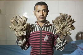 Kinh hãi người đàn ông mắc hội chứng người cây