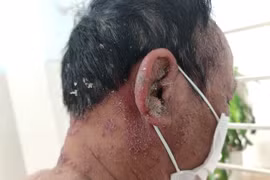 Trị vẩy nến bằng Đông y: Loạn sản phẩm, công dụng