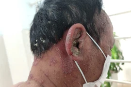 Trị vẩy nến bằng Đông y: Loạn sản phẩm, công dụng