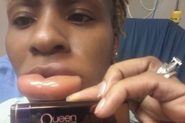 Cô gái sưng vù môi như quả chuối vì son môi