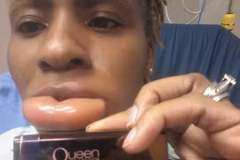 Cô gái sưng vù môi như quả chuối vì son môi