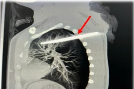 Cứu bệnh nhân 29 tuổi bị dao xuyên thấu lưng, cắm sâu trong phổi