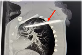 Cứu bệnh nhân 29 tuổi bị dao xuyên thấu lưng, cắm sâu trong phổi