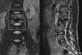 Đau lưng nam thanh niên không ngờ lao cột sống
