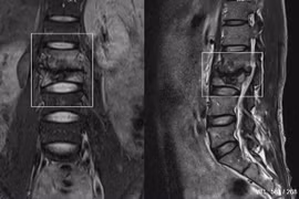 Đau lưng nam thanh niên không ngờ lao cột sống