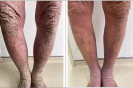 Nhiều người viêm da cơ địa nặng do tự ý điều trị