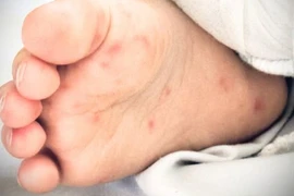 TP.HCM bệnh tay chân miệng tăng, bác sĩ lưu ý nguy cơ tái nhiễm