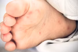 TP.HCM bệnh tay chân miệng tăng, bác sĩ lưu ý nguy cơ tái nhiễm