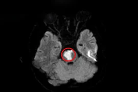 Mới 17 tuổi đã nhồi máu não, cẩn thận khi điều trị tại nhà