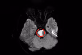 Mới 17 tuổi đã nhồi máu não, cẩn thận khi điều trị tại nhà