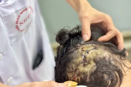 Bé gái 5 tuổi bị chó lớn trong nhà tấn công 10 vết thương vào đầu