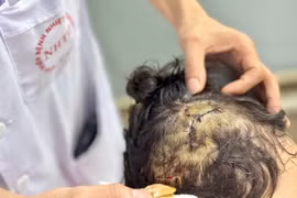 Bé gái 5 tuổi bị chó lớn trong nhà tấn công 10 vết thương vào đầu