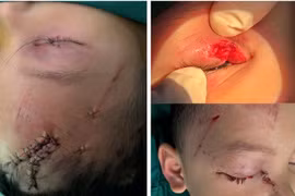 Tổn thương chó cắn ở trẻ - Ảnh BVCC