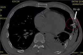 Không thấy vết thương nhưng xương sườn gãy đâm thủng phổi