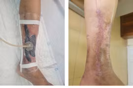 Điều trị hút áp lực âm tránh cắt cụt chi cho người đái tháo đường