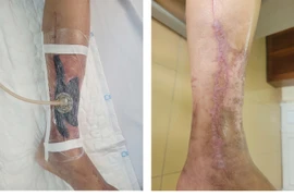 Điều trị hút áp lực âm tránh cắt cụt chi cho người đái tháo đường