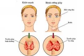 Bệnh Basedow điều trị iốt phóng xạ có gây ung thư?