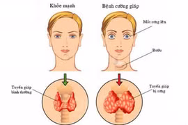 Bệnh Basedow điều trị iốt phóng xạ có gây ung thư?