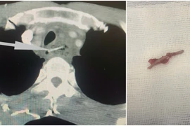 Nhiều ca bệnh bị dị vật đường ăn: Đừng chủ quan biến chứng nguy hiểm