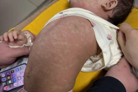 Các bệnh liên quan đến tử vong do sởi