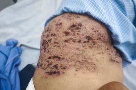 Nhiều người biến chứng nguy kịch do chủ quan với zona thần kinh