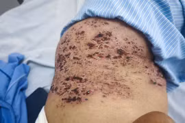 Nhiều người biến chứng nguy kịch do chủ quan với zona thần kinh