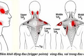 Hội chứng đau cơ xơ hóa là gì?