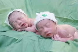 Hành trình kì diệu ca song thai chung bánh rau buồng ối, dây rốn thắt nút