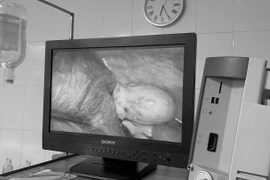 Nội soi tách u bì buồng trứng xoắn bảo toàn thai nhi 20 tuần