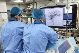 Hết liệt nửa người do đột quỵ nhờ can thiệp mạch máu não kịp thời