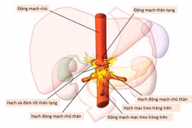 Kỹ thuật giảm đau bụng bằng diệt đám rối thần kinh tạng