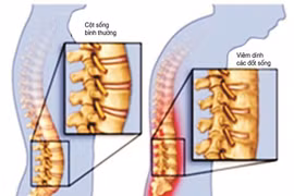 Đau lưng cẩn thận viêm cột sống dính khớp dễ gây tàn phế