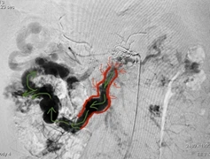 12h "cân não" cắt 3m ruột non cứu người đàn ông mắc bệnh hiếm
