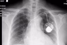 Đặt máy tạo nhịp cứu bệnh nhân tắc nghẽn đường dẫn truyền trong tim