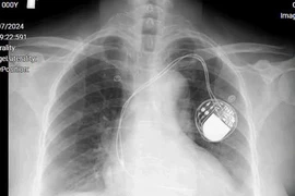 Đặt máy tạo nhịp cứu bệnh nhân tắc nghẽn đường dẫn truyền trong tim