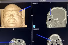 Lấy bỏ viên đạn nằm sâu trong sọ não nhờ định vị dẫn đường Navigation