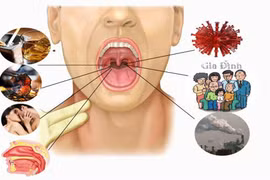 Yếu tố gây nguy cơ ung thư vòm hầu họng nhiều người mắc